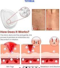 Derma Smooth Skin Tag Removal Patch Kashio Fast Acting Painless Skin Tag and Mole Remover Patch Natural Formula for Clear Smooth Skin Safe for All Skin Types